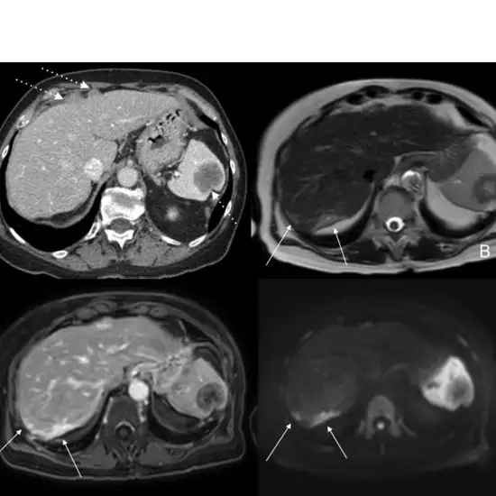 MRI Multiphasic Upper Abdomen
